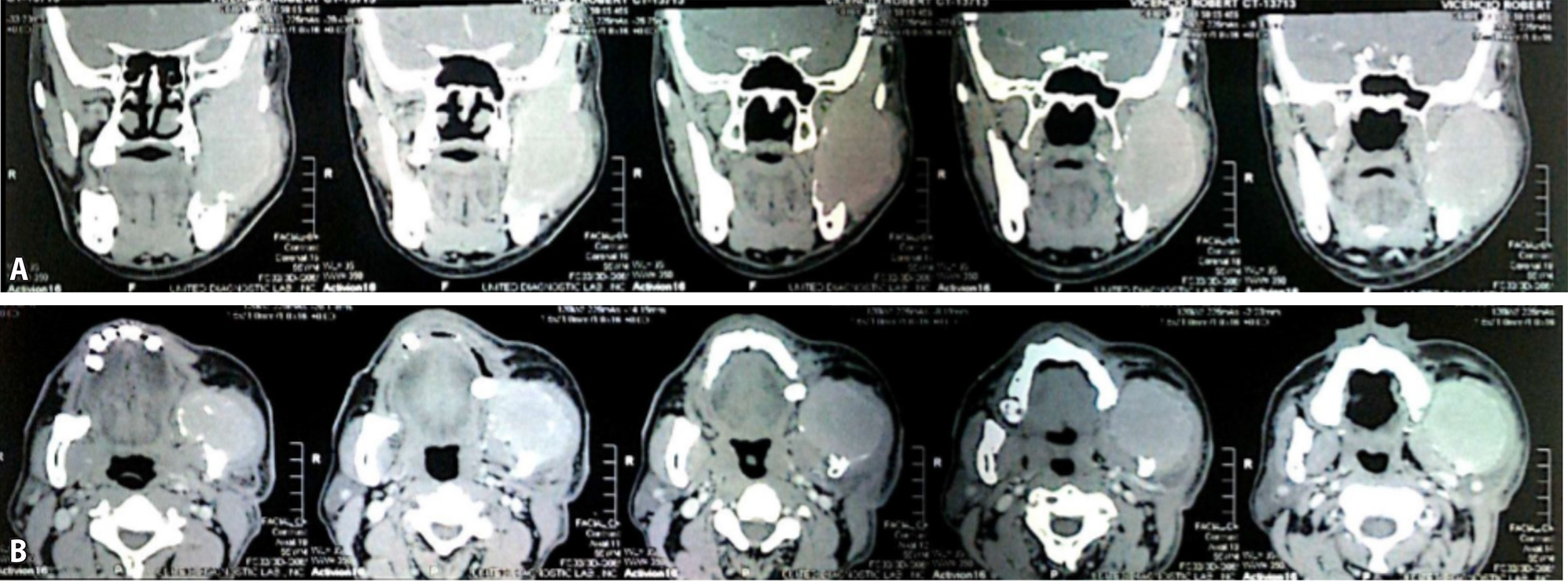 multiple myeloma mandible