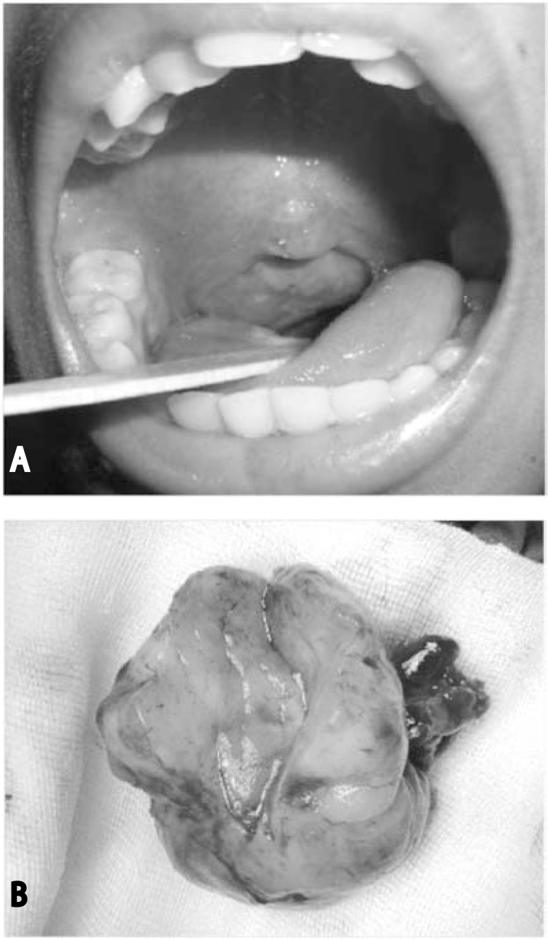 Anterior rhinoscopy findings; A. Patent right nasal cavity; B