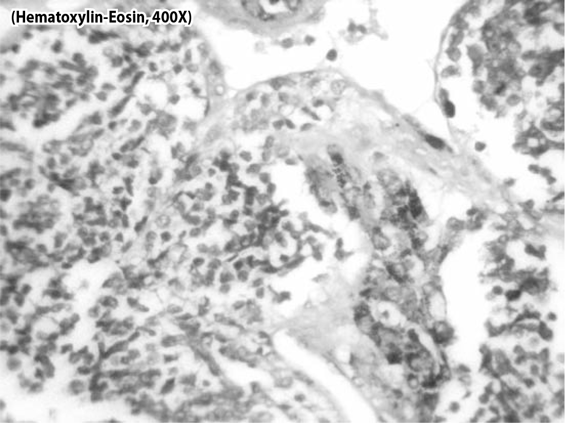 melanotic neuroectodermal tumor of infancy histology Melanotic Neuroectodermal Tumor of Infancy main image 0